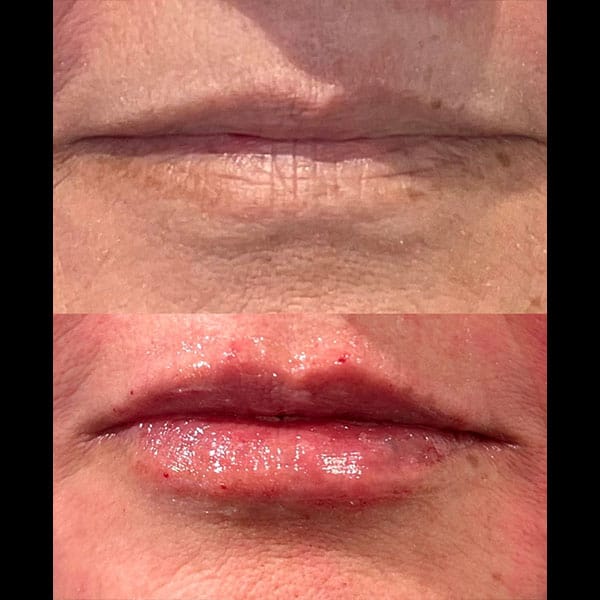 before and after Versa Lip Filler