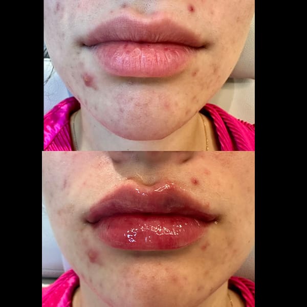 before and after Versa Lip Filler